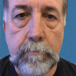 Mohs Nose Patient 03 Thumbnail Before