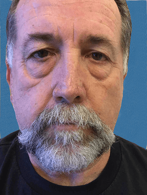 Mohs Nose Patient 03 Before