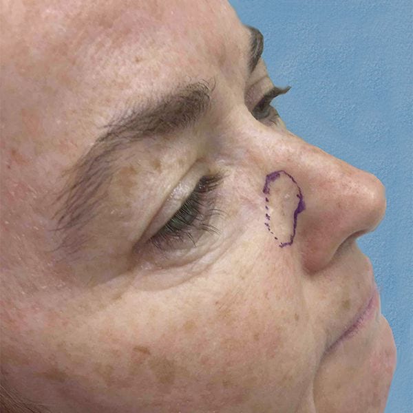 Mohs Nose Patient 02 Before