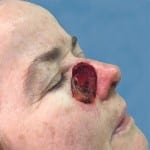 Mohs Nose Patient 02 Thumbnail After