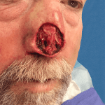 Mohs Nose Patient 03 Thumbnail After