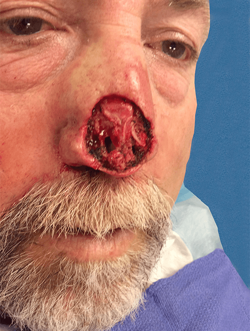 Mohs Nose Patient 03 After