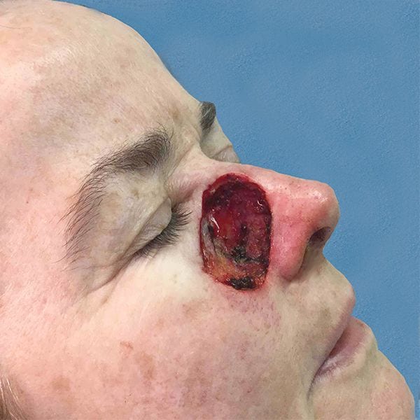 Mohs Nose Patient 02 After