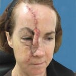 Mohs Nose Patient 02 Thumbnail Before - 2