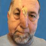 Mohs Nose Patient 03 Thumbnail Before - 2