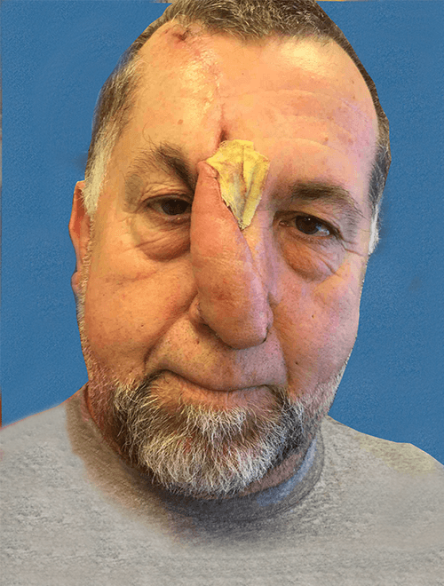 Mohs Nose Patient 03 Before - 2