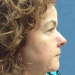 Mohs Nose Patient 02 Thumbnail After - 2