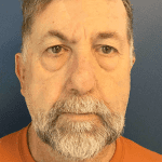 Mohs Nose Patient 03 Thumbnail After - 2