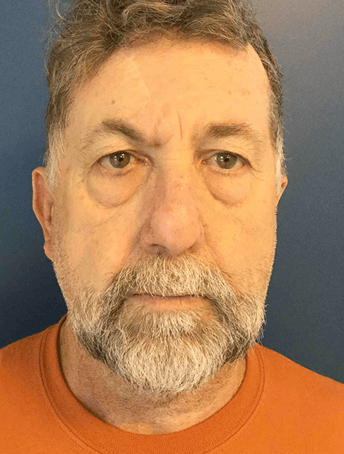 Mohs Nose Patient 03 After - 2