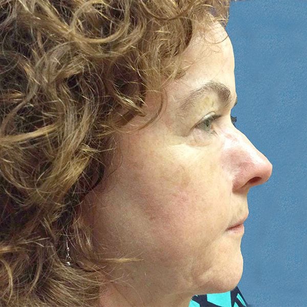 Mohs Nose Patient 02 After - 2