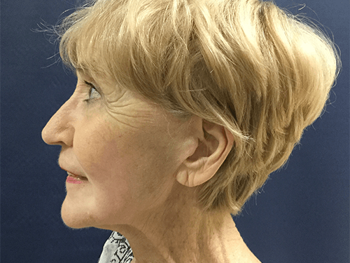Facelift Patient 01 After - 2