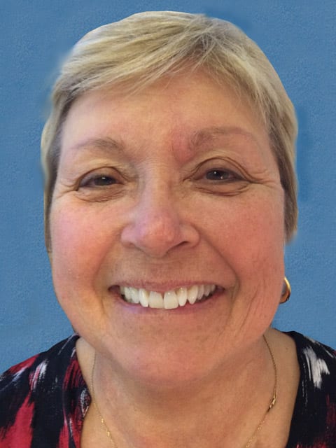 Mohs Nose Patient 01 After - 2