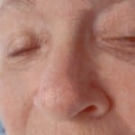 Mohs Nose Patient 01 Thumbnail Before