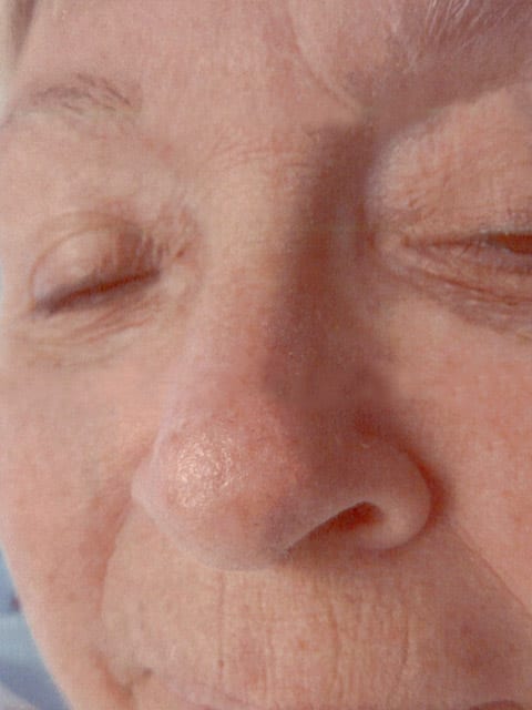 Mohs Nose Patient 01 Before