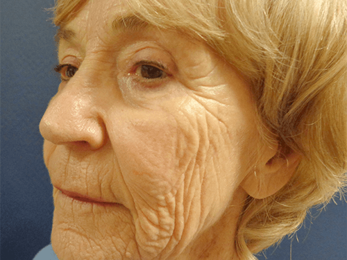 Facelift Patient 01 Before - 2