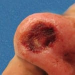 Mohs Nose Patient 01 Thumbnail After