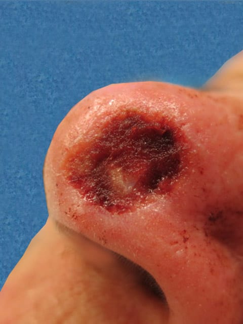 Mohs Nose Patient 01 After