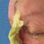 Mohs Nose Patient 01 Thumbnail Before - 2