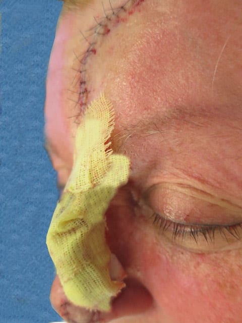 Mohs Nose Patient 01 Before - 2