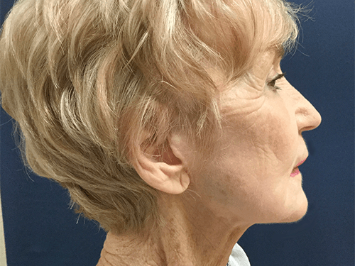 Facelift Patient 01 After