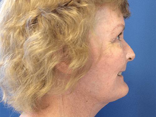 Facelift Patient 02 After - 2