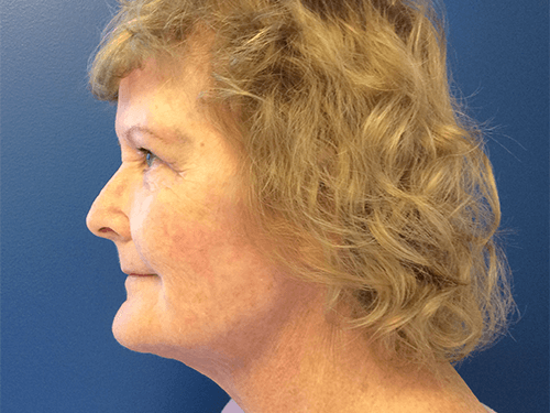 Facelift Patient 02 After