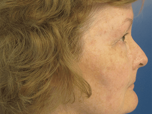 Facelift Patient 02 Before - 2