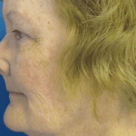 Facelift Patient 02 Thumbnail Before