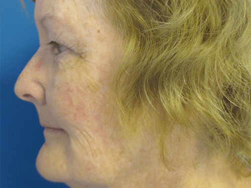 Facelift Patient 02 Before