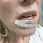 Mohs Lips Patient 01 Thumbnail Before