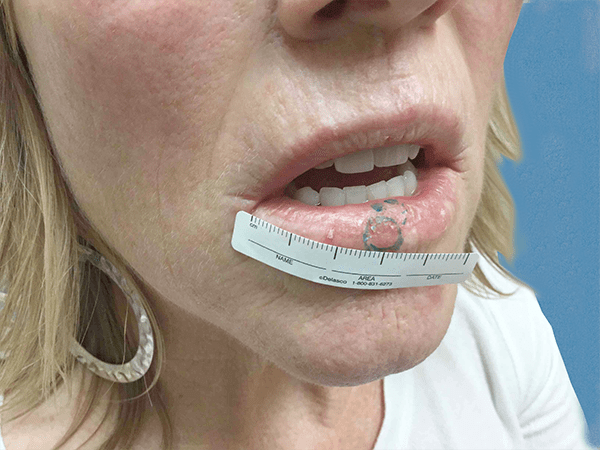 Mohs Lips Patient 01 Before