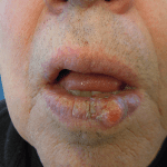 Mohs Lips Patient 02 Thumbnail Before