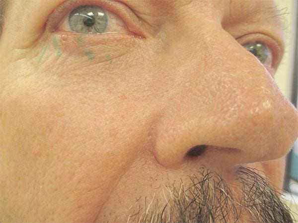 Mohs Eyes Patient 01 Before