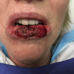 Mohs Lips Patient 01 Thumbnail After