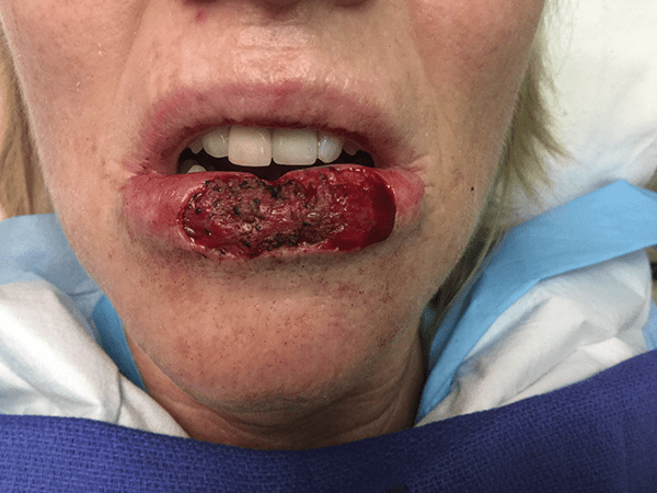 Mohs Lips Patient 01 After