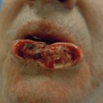 Mohs Lips Patient 02 Thumbnail After