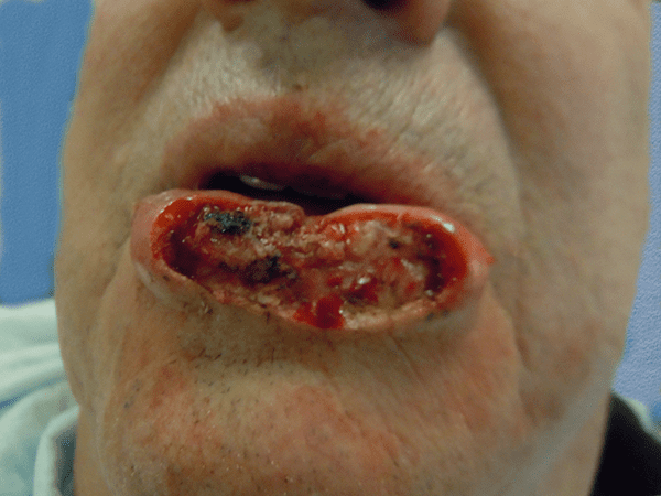 Mohs Lips Patient 02 After