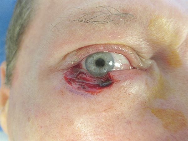 Mohs Eyes Patient 01 After