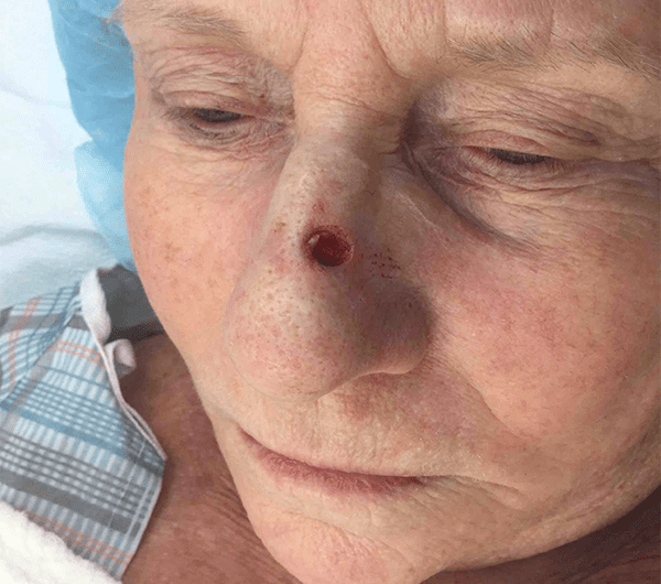 Mohs Nose Patient 04 After