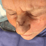 Mohs Nose Patient 04 Thumbnail Before - 2