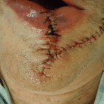 Mohs Lips Patient 02 Thumbnail Before - 2