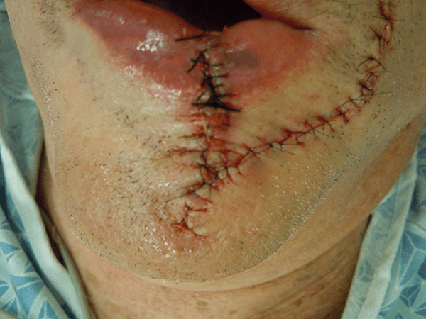 Mohs Lips Patient 02 Before - 2