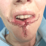 Mohs Lips Patient 01 Thumbnail Before - 2