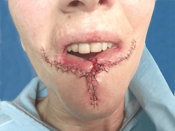 Mohs Lips Patient 01 Before - 2