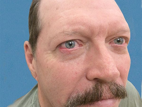 Mohs Eyes Patient 01 Before - 2