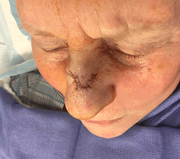 Mohs Nose Patient 04 Before - 2
