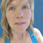 Mohs Lips Patient 01 Thumbnail After - 2