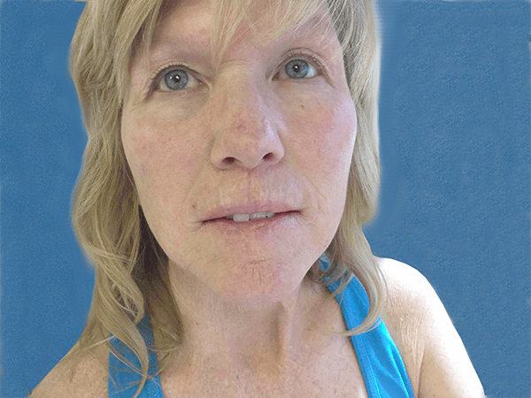 Mohs Lips Patient 01 After - 2