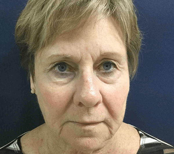 Mohs Nose Patient 04 After - 2