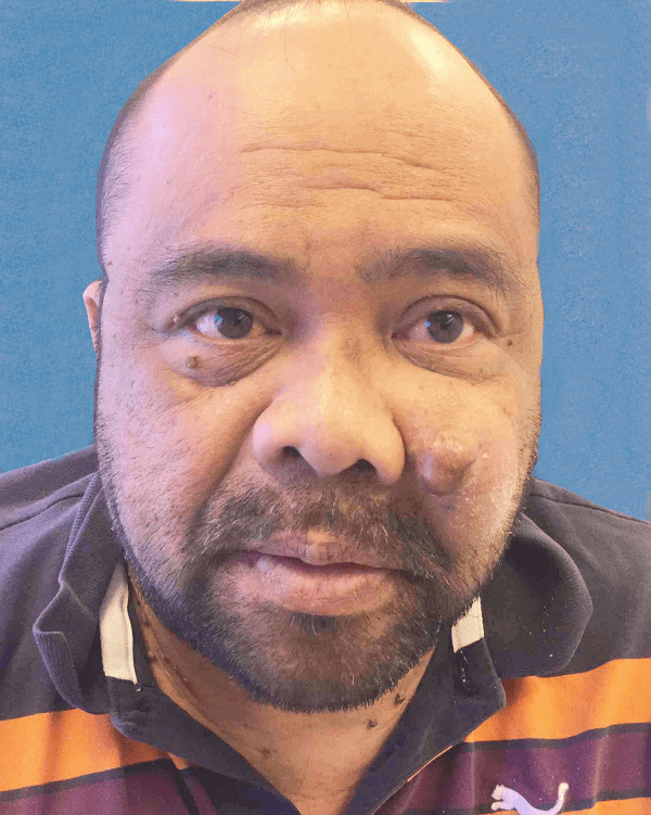 Mohs Face Patient 01 Before